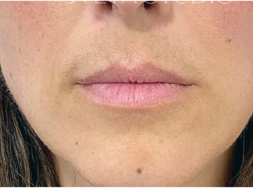 After FaceStim treatment 1