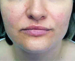 After FaceStim treatment 2