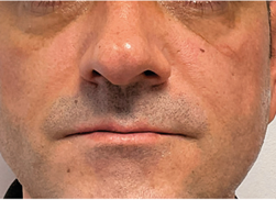 After FaceStim treatment 3