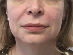 After FaceStim treatment 4