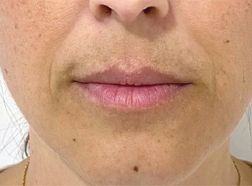 Before FaceStim treatment 1