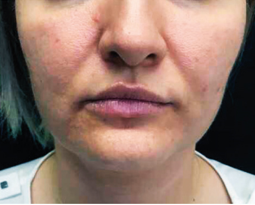 Before FaceStim treatment 2