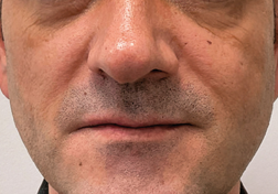 Before FaceStim treatment 3