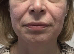 Before FaceStim treatment 4