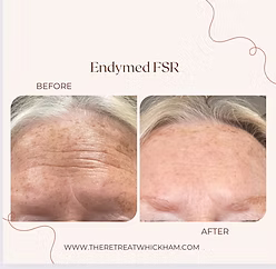 EndyMed FSR before & after